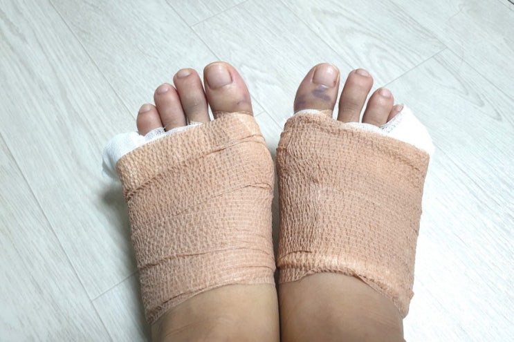  JJ의 하루 : 무지외반증, 소건막류 수술 후기 10일차 (양발 수술때 샤워하는 방법)