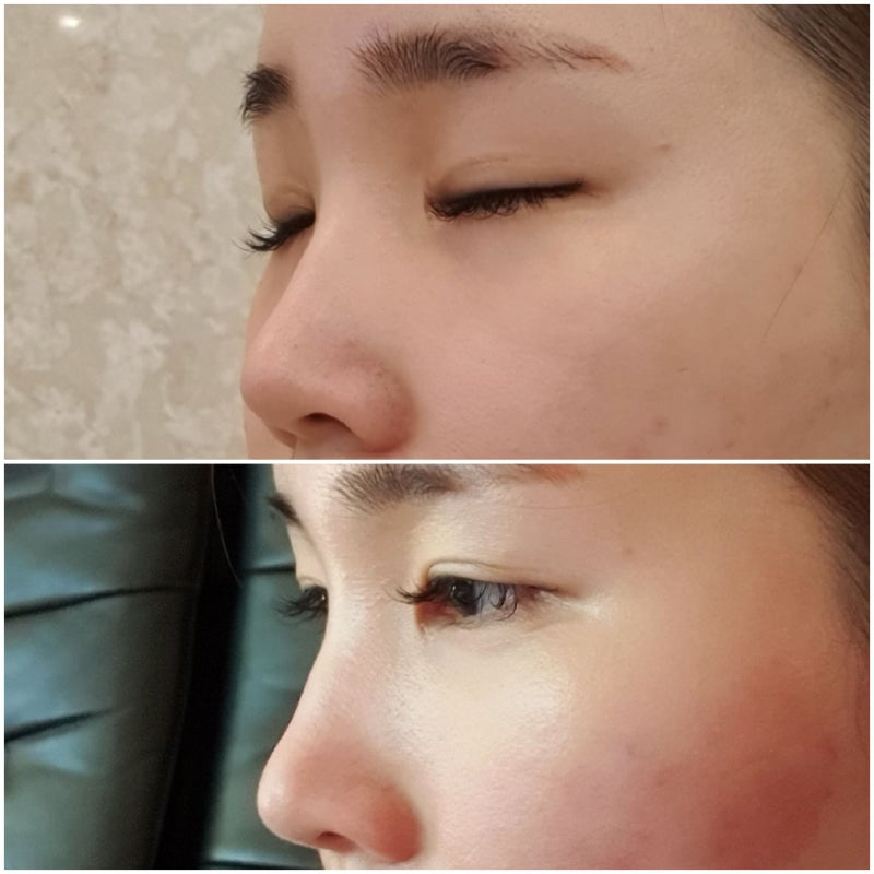 천호역 피부과 광대축소술 시술결과 (산후안면성형 2차)