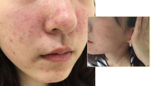 얼굴 지루성피부염 증상 치료 연고 + 관리법 : 네이버 블로그