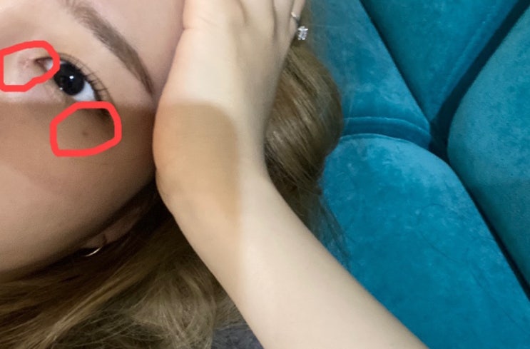  비립종 제거 흉짐