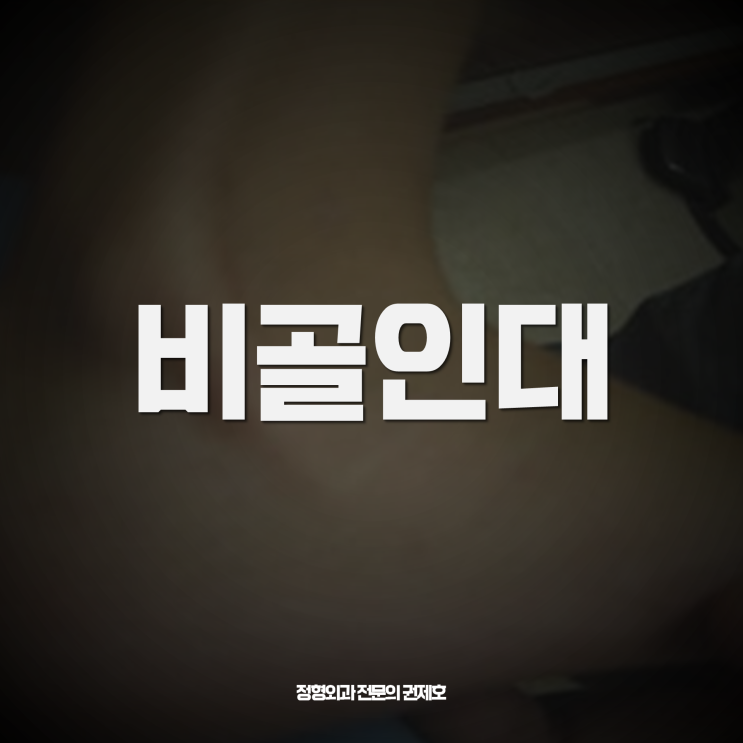  발목 꺾여서 생긴 비골건탈구 D/L