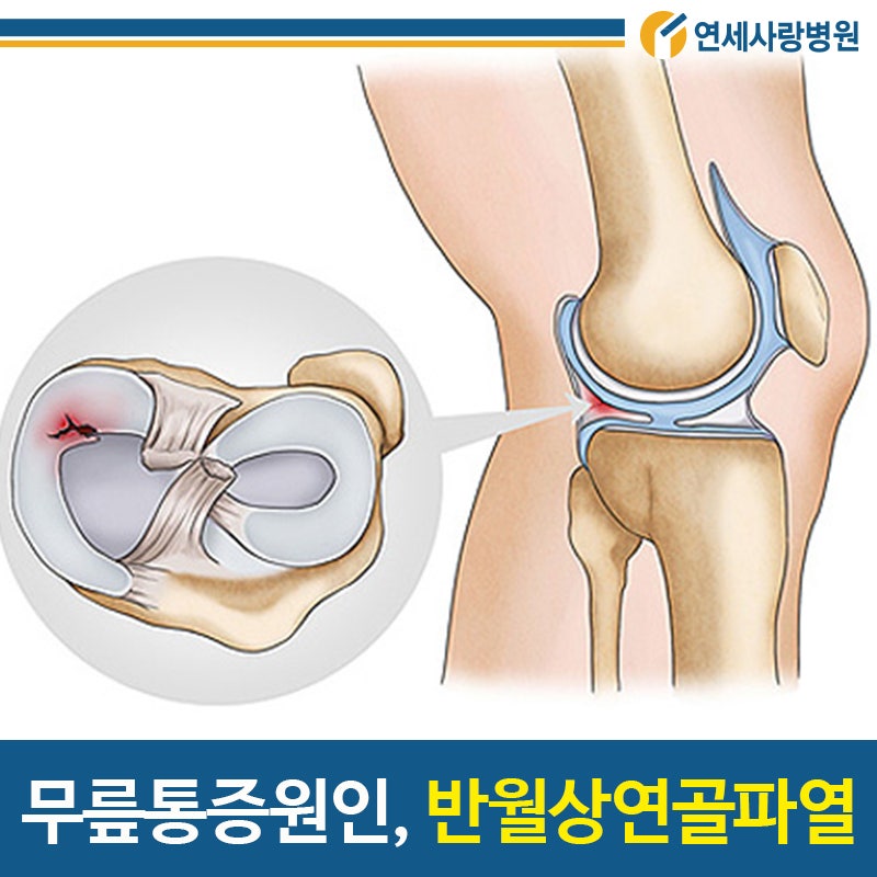 무릎관절염부터 반월상연골파열까지,