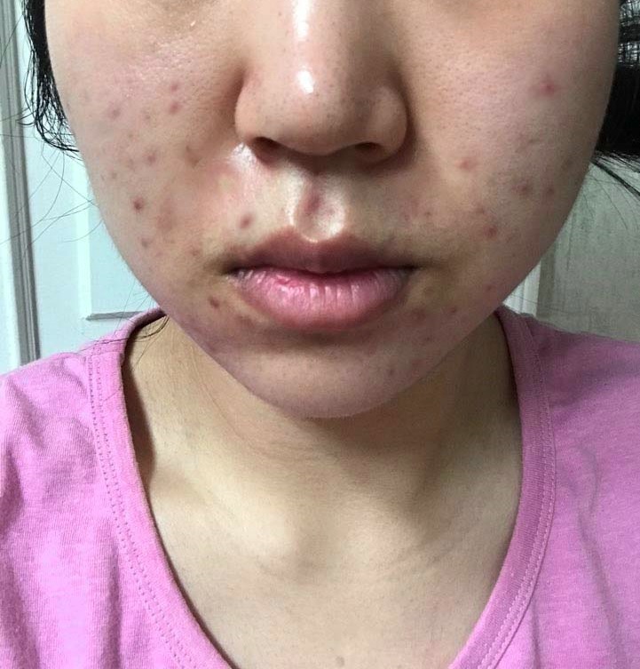  이소티논 총복용량 채웠는데 리유한의원 박해웅원장님께 모낭염진단받았습니다