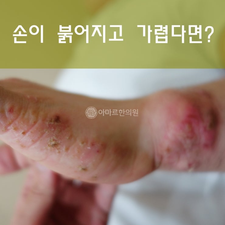 몸 가려움증 온몸이 간지러워요 손 발 11