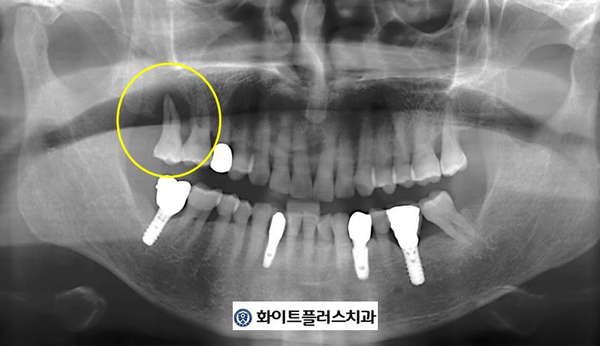 보라매역 임플란트 치과, 발치후 오래 기다려 뼈이식 없이 식립