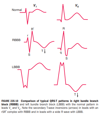 응급의학과 예습 (3) : Major ECG abnormalities : 네이버 블로그