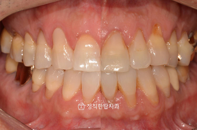  분당치아미백 원데이로 밝은 미소를 (OSSTEM Beautis)