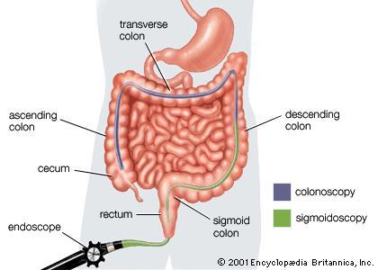 sigmoidoscopy vs colonoscopy 차이점 간호사가 정리