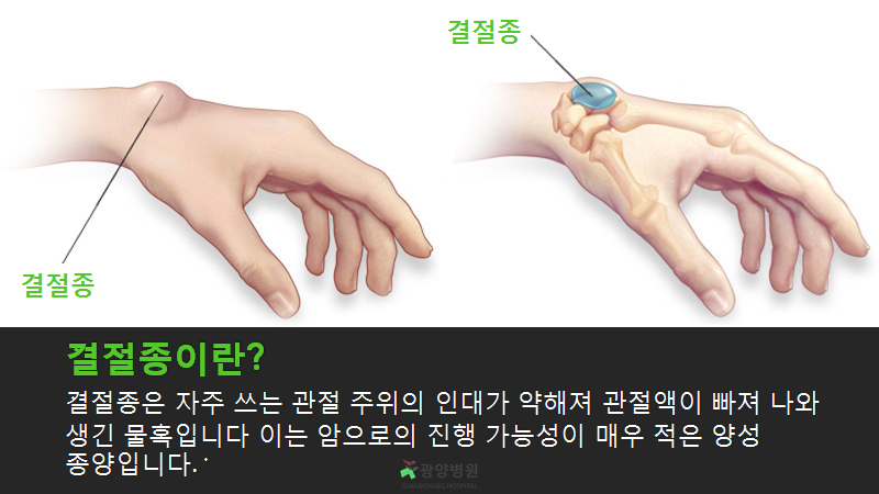 손가락에 결절종이 생긴 후 수술을 해야 하는 이유 9