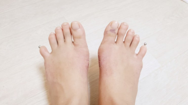  JJ의 오늘 : 무지외반증, 소건막류 수술 후기 13, 14, 15일차 (샤워가능, 흉터연고 시작, 수술전 후 비교샷)