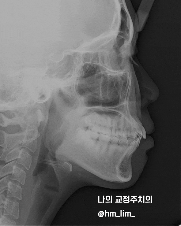 비대칭과 잇몸미소 그리고 입 돌출 케이스 리뷰/ 발치교정하면 인중길이가 변할까? - 미사 교정치과 비대칭과 잇몸미소 그리고 입 돌출 케이스 리뷰/ 발치교정하면 인중길이가 변할까? - 미사 교정치과
