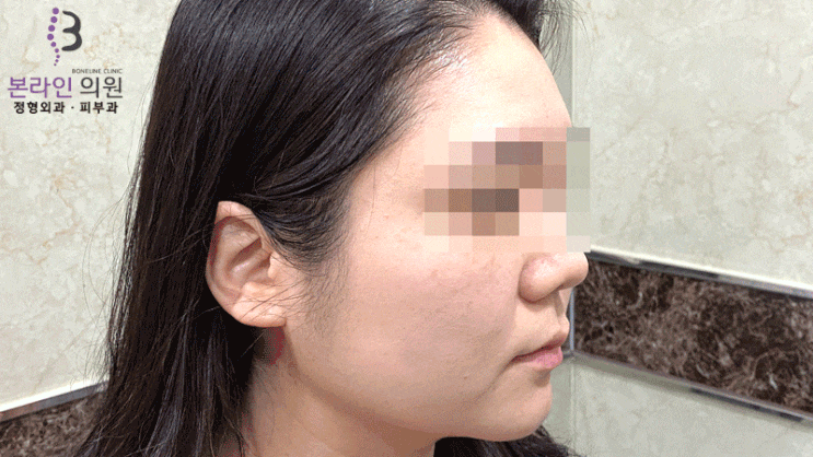  울쎄라리프팅을 효과를 보셨다면 더 좋은 울트라스킨플러스리프팅