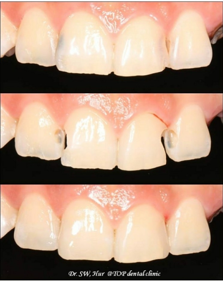 예쁜 치아 만들기 프로젝트 -앞니 충치 레진치료