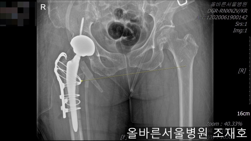 대퇴골 전자간 골절 수술 후 39일 1