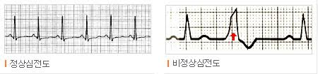  EKG심전도 기본파형 사지유도 4편 : 부정맥리듬 동방결절의 부정맥 빈맥
