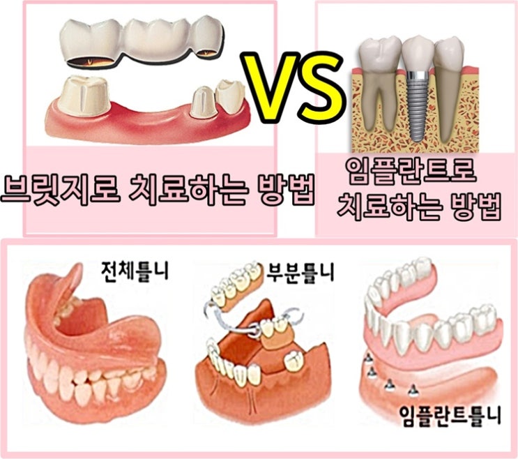  임플란트,브릿지,틀니 비교해보기!