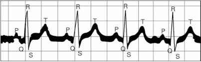 EKG심전도 기본파형 사지유도 3편 : 심전도해석 정상리듬 심실비대 심근경색