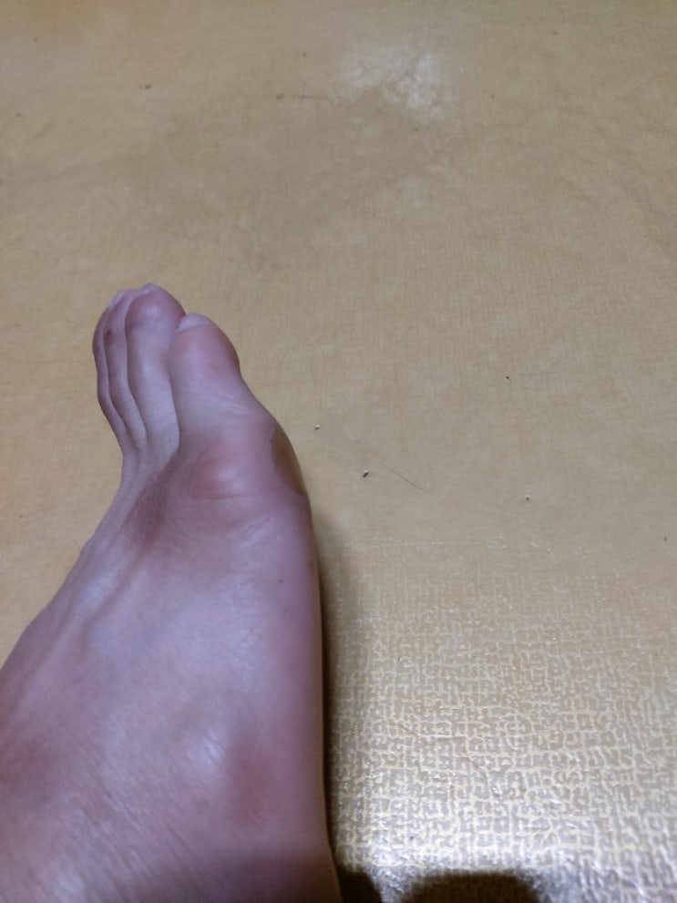  티눈 사마귀 구별법 알아본 후 티눈 사마귀 없애는 방법