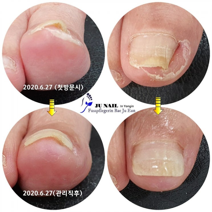 발톱수술 무서워서 계속 참고만 지내신 81세 할머니의 엄지발톱염증/분당용인수원수지보정동백죽전동/주네일/무좀파고드는내향성염증발톱손톱변형전문네일샵