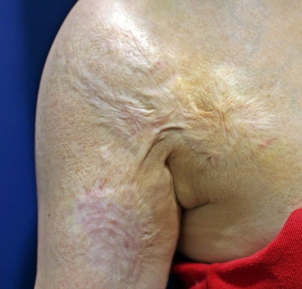 오래된 심재성 2도, 3도 화상 흉터 치료, 색소 침착 레이저 치료 사진 : 강서구 화곡 리뉴미 피부과