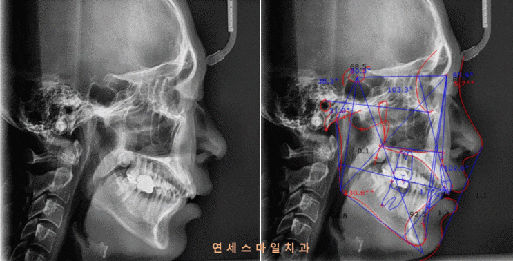  치아교정시에 교정진단과 진단비란 무엇일까요?