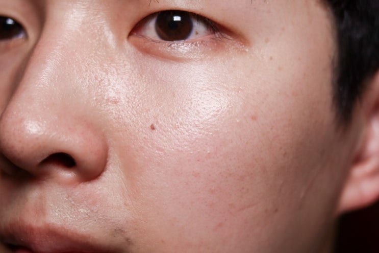  넓어진 모공케어와 블랙헤드관리 어떻게 해야 할지 알려드려요.