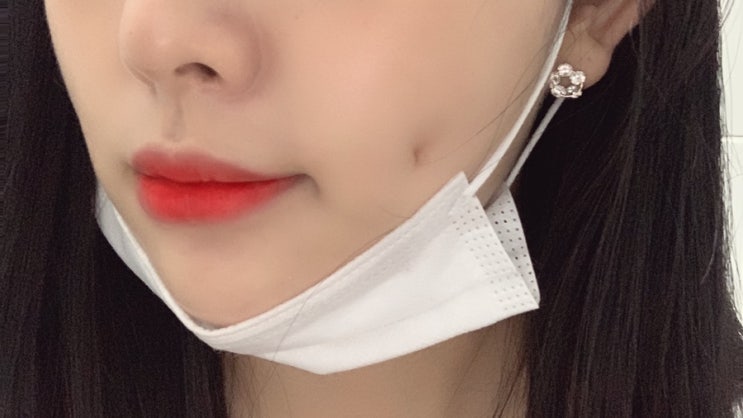  내돈 보조개수술 4일차 후기 : 수술 후 첫출근