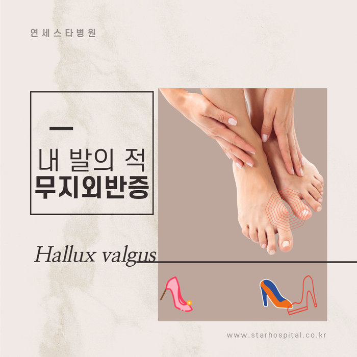 무지외반증, 여름패션의 복병 / 연세스타병원