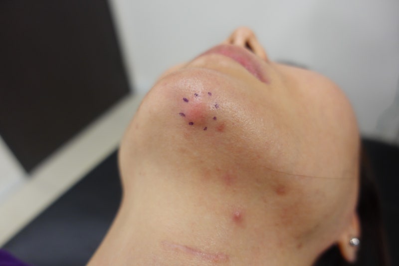 얼굴 피지낭종 제거 흉터 최소화