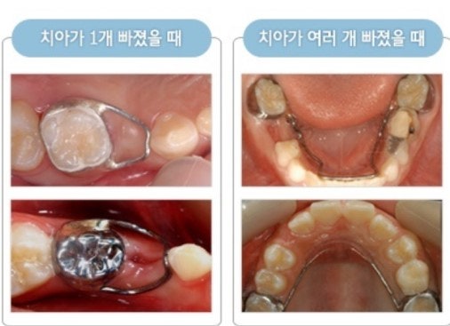 유치 발치 및 공간 유지 장치에 대하여