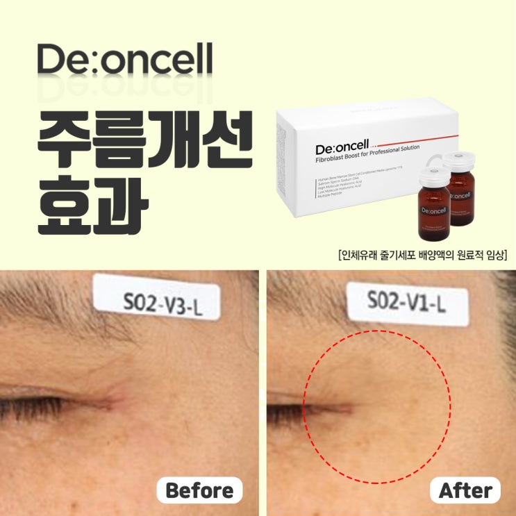  디온셀 파이브로블라스트 부스트 포 프로페셔널 솔루션의 효과