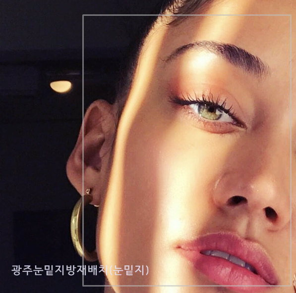  광주눈밑지(눈밑지방재배치) 완전 간단한 수술 아닌가요?