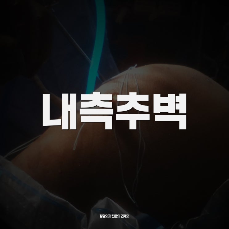  추벽증후군, 무릎걸림 locking 원인! / 제이본정형외과 권제호