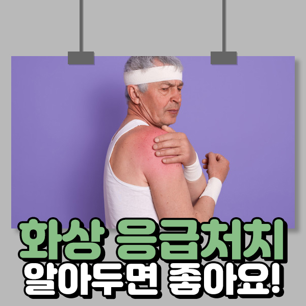  화상 응급처치 알아두면 좋아요