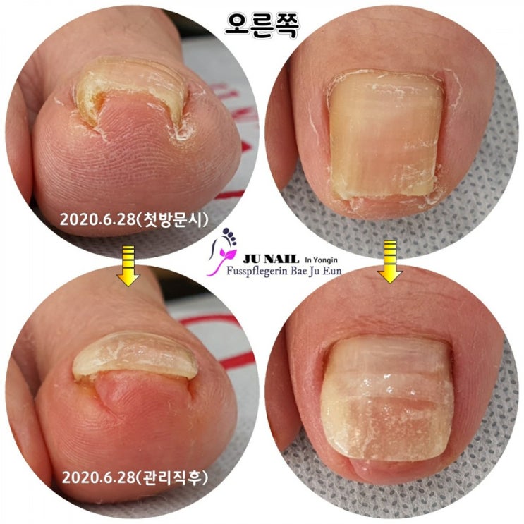 내성발톱으로 인한 통증때문에 걸을수가 없어요./분당용인수원수지보정동백죽전동/주네일/무좀파고드는내향성염증발톱손톱변형전문네일샵