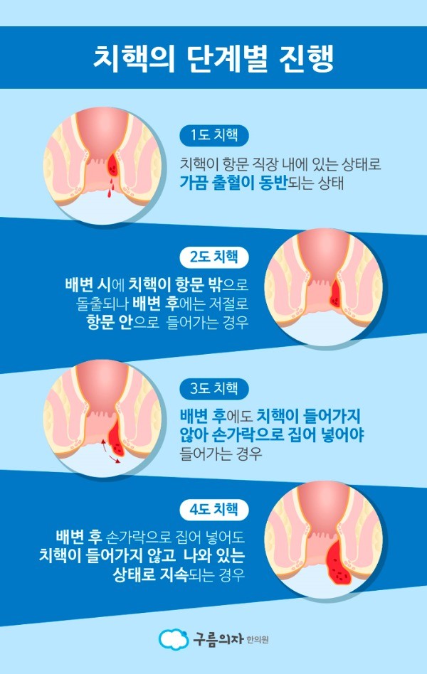 [치질 수술 후기] 항문 관리에 힘쓴 방법