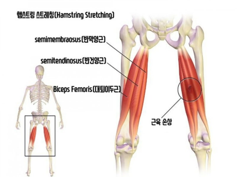 힘줄(=건 tendon)파열 수술: Rt hamstring tendon rupture -> Open hamstring ...