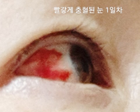  <눈 건강>눈 충혈 실핏줄이 터진 눈 치료