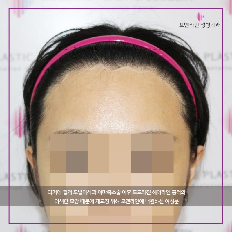 이마 축소 수술 후기(회복 기간, 상처, 비용), 이마 반M자 탈모 탈출기. 9