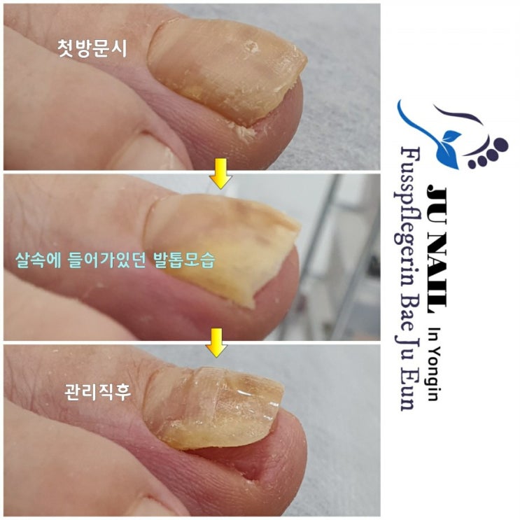 무좀발톱인지 몰랐어요. /분당용인수원수지보정동백죽전동/주네일/무좀파고드는내향성발톱손톱변형전문네일샵 무좀발톱인지 몰랐어요. /분당용인수원수지보정동백죽전동/주네일/무좀파고드는내향성발톱손톱변형전문네일샵