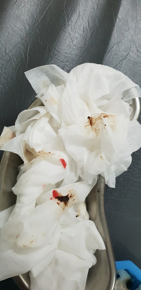  Hematemesis 토혈 간호사가 쉽게 정리
