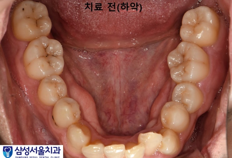  전악 충치치료, 보철치료, 레진치료, 원주 무실동 삼성서울치과에서 충치치료 하기