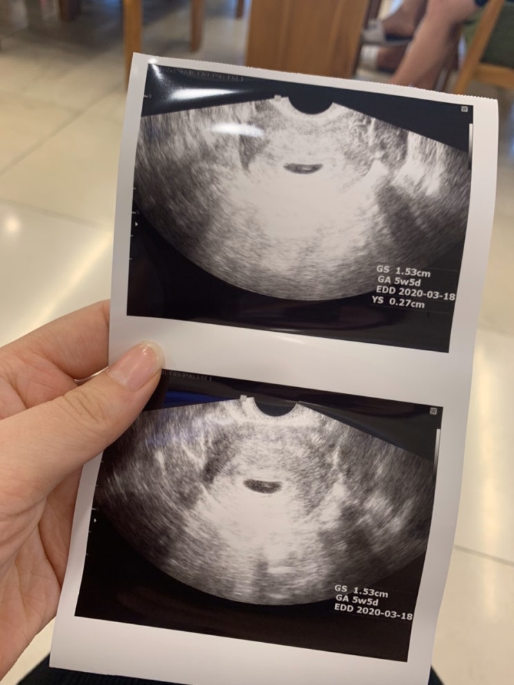  햇살 가득한 날 (임신 5-6주) 그리고 태몽