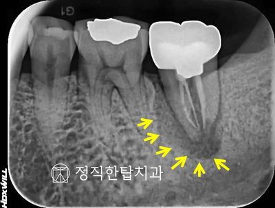 치조제보존술(ARP)로 안전함을 추구합니다