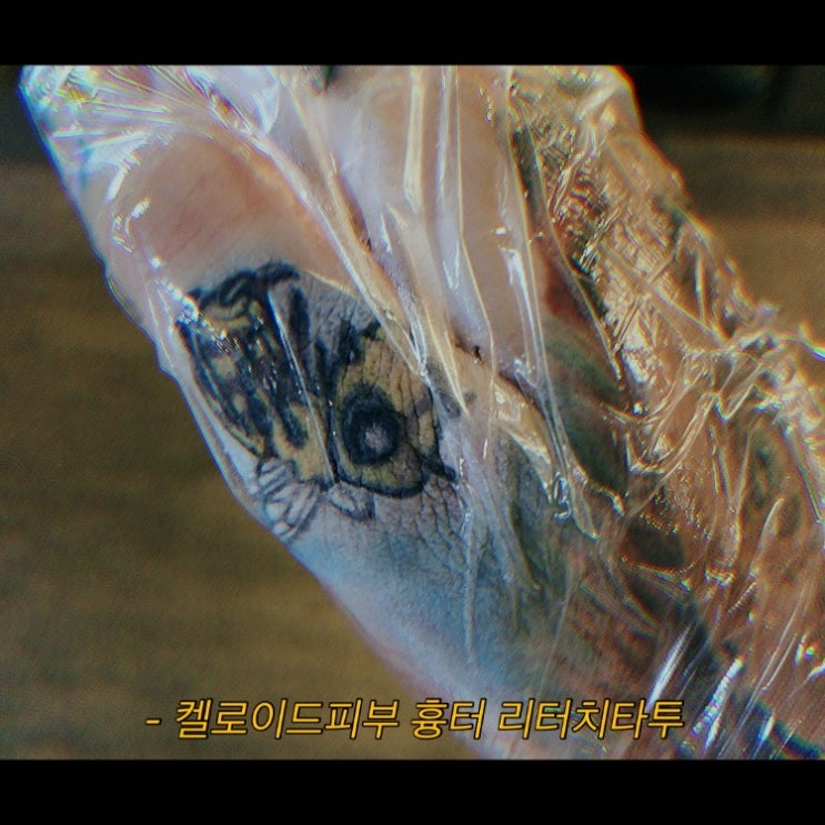  [의정부타투 화담] 손가락 켈로이드 흉터 커버업타투 뉴스쿨 꿀벌타투