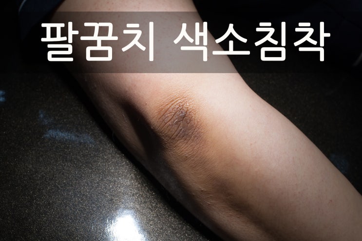  팔꿈치 색소침착 표피 제거술