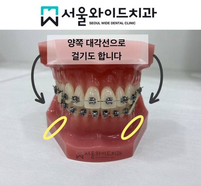 치아교정 고무줄 언제할까? 착용 기간, 통증, 주의사항, 거는 방법에 대해 : 네이버 블로그 치아교정 고무줄 언제할까? 착용 기간, 통증, 주의사항, 거는 방법에 대해 : 네이버 블로그