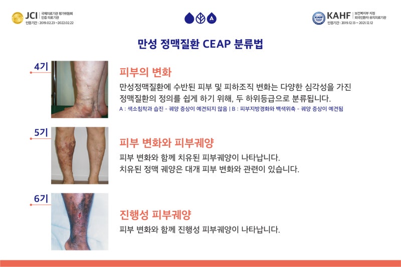 전주하지정맥 만성정맥부전이 진행되었다는 증상 3