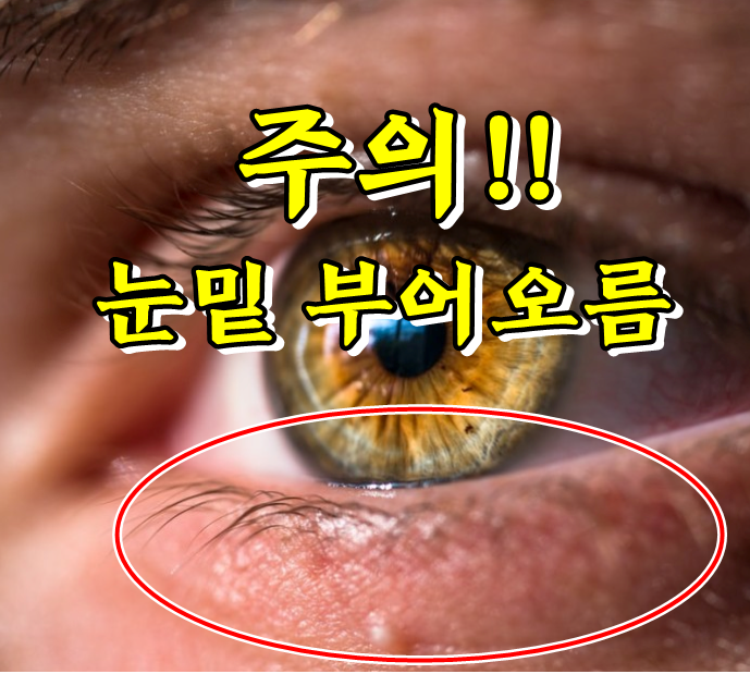  눈밑 부어오름 평소에 주의하세요!