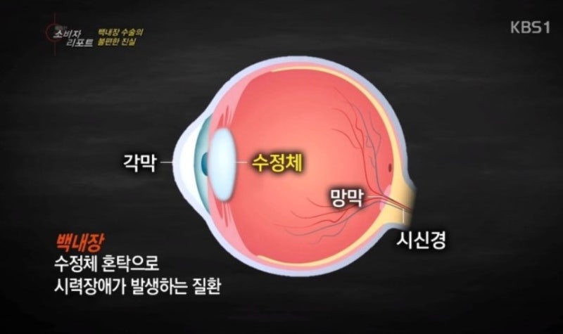 전주백내장수술, 노안과 다른점은?